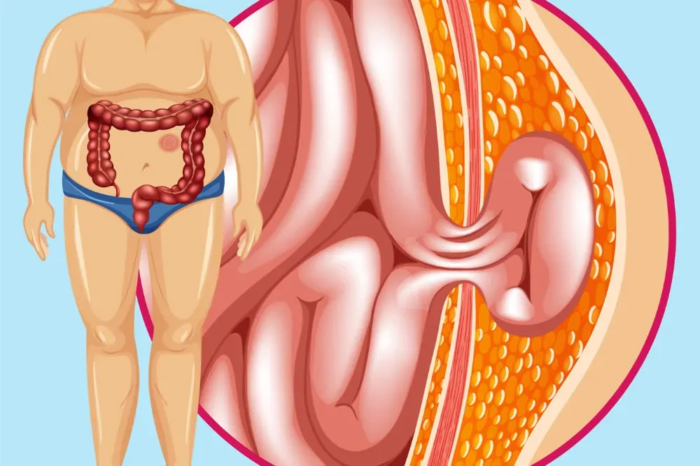 Hernias